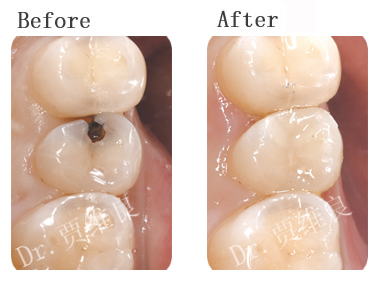 dr.贾维良病例分享 树脂补牙与嵌体补牙哪个好