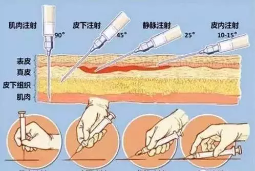 申洋:微整形注射需要注意哪些?