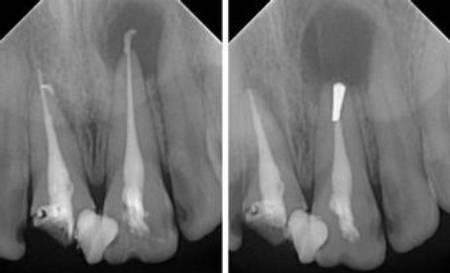 科技 正文  根尖诱导成形术对有些病例在早期成功后有可能再次失败