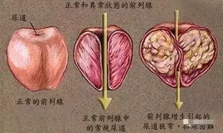 前列腺肥大痛苦不堪,靠灸一穴治愈!