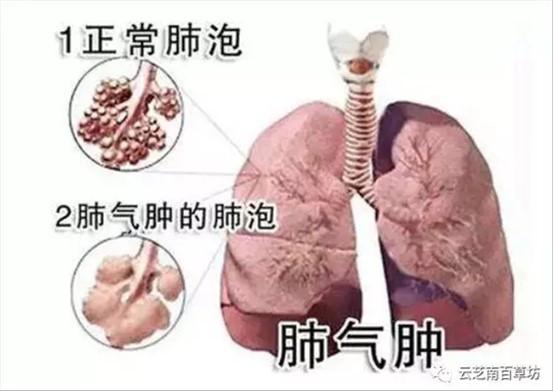 缩唇呼吸的原理_缩唇呼吸的缩唇呼吸简介