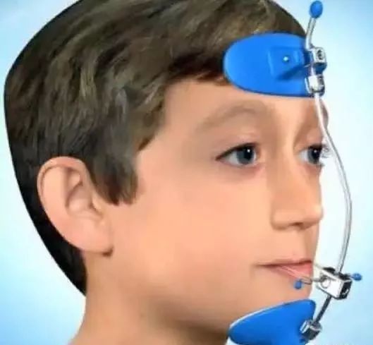 头帽颏兜装置可以调节颌骨生长治疗儿童地包天