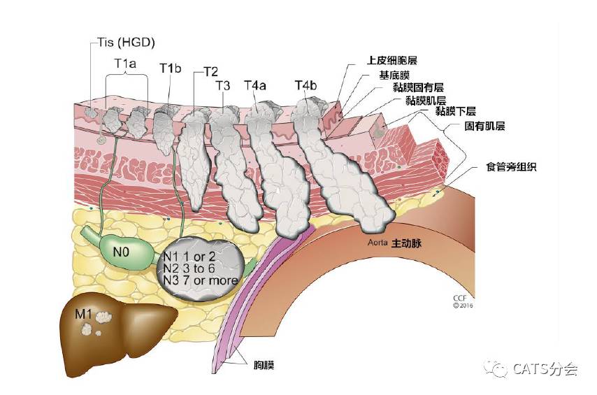 1.1施行---ajcc第8版食管及食管胃交界部癌tnm