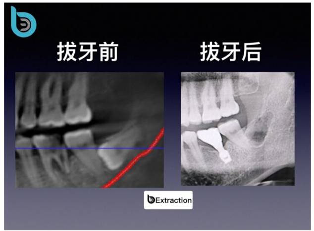 下颌低位阻生智齿拔除 完全骨埋伏阻生 微创拔牙 导板