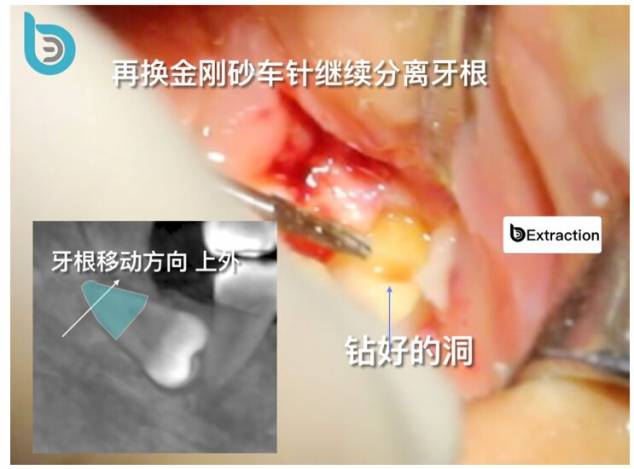 下颌低位阻生智齿拔除 完全骨埋伏阻生 微创拔牙 导板