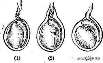 "蛋疼的情况发生,临床上容易将睾丸扭转与睾丸炎,附睾炎,疝气,睾丸