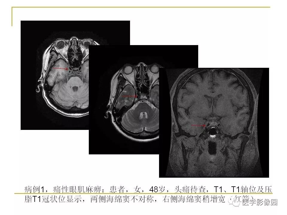 痛性眼肌麻痹综合征(tolosa-hunt综合征)临床及影像丨