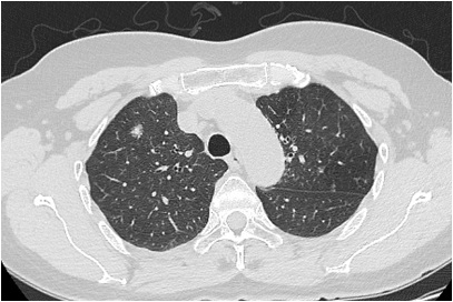早期肺癌除了完全没有任何症状这一情况外,还可能有哪些症状呢?