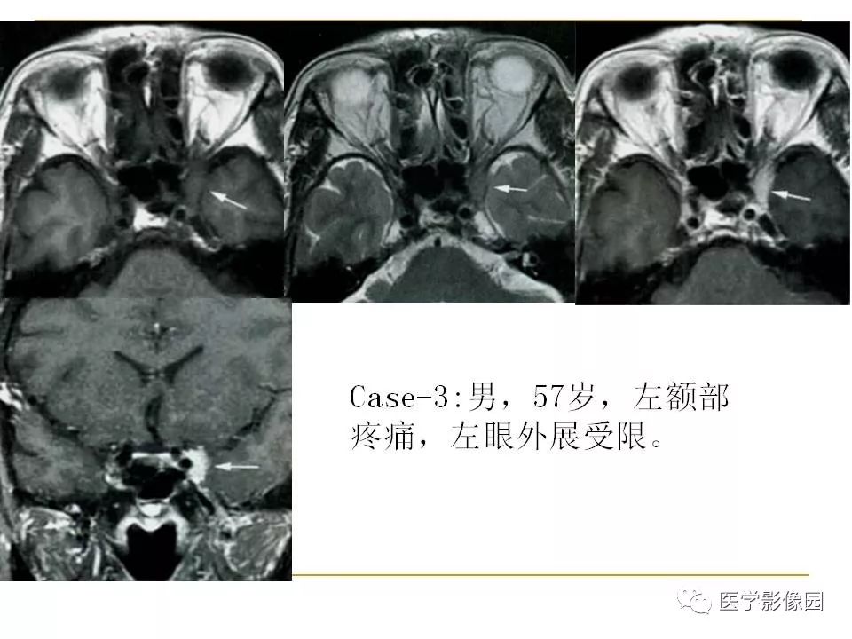 痛性眼肌麻痹综合征(tolosa-hunt综合征)临床及影像丨