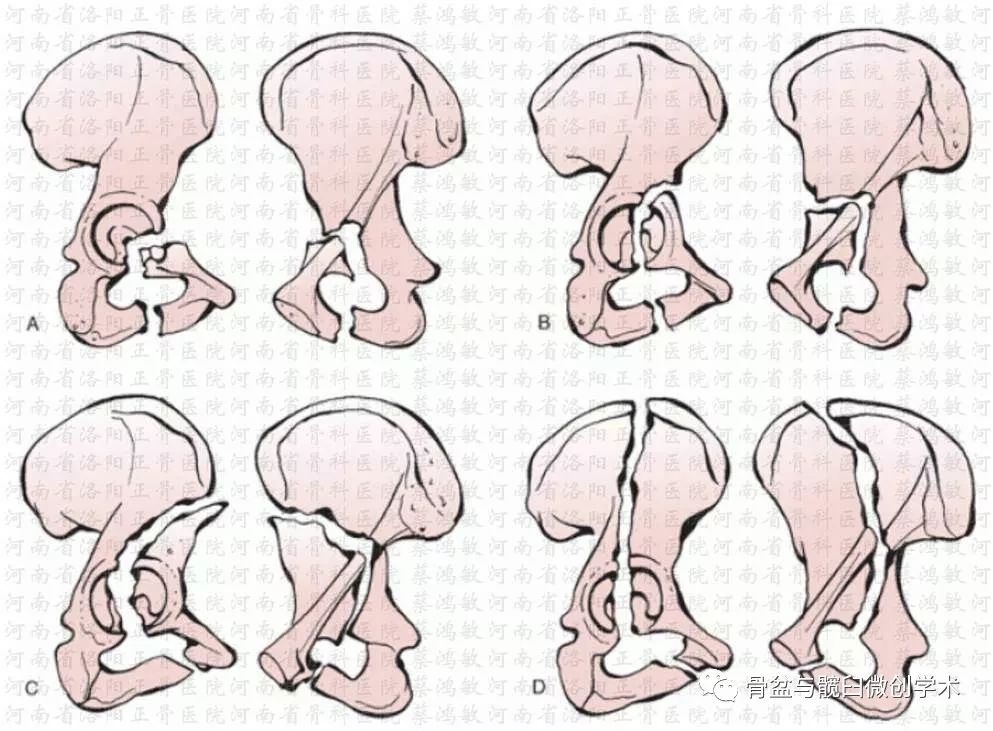 髋臼骨折分型