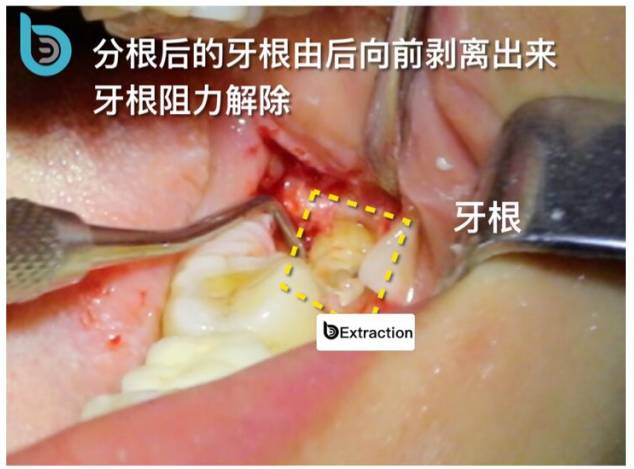 下颌低位阻生智齿拔除 完全骨埋伏阻生 微创拔牙 导板
