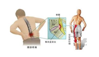 别小看农村的土方法,一个土方法,治好了很多人的腰椎病