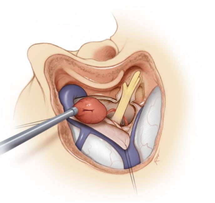 经迷路入路手术策略与技巧 | the neurosurgical atlas全文翻译