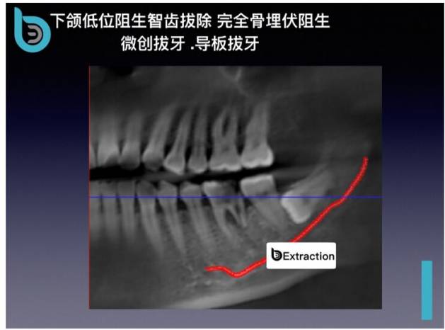 下颌低位阻生智齿拔除 完全骨埋伏阻生 微创拔牙 导板