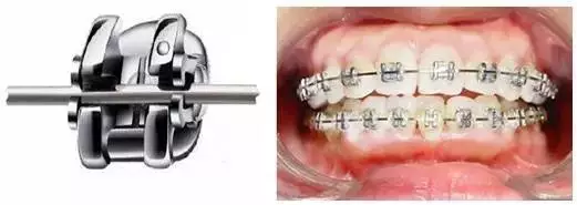 自锁金属托槽正畸被誉为"牙齿矫正经典之选",是我们常见的矫正技术之