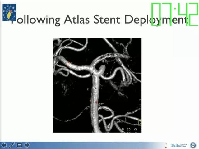 neuroform atlas支架治疗颅内动脉瘤