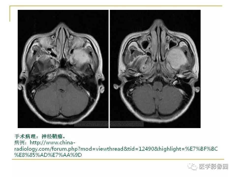 翼腭窝影像解剖及常见病变丨影像天地