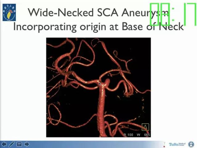 neuroform atlas支架治疗颅内动脉瘤