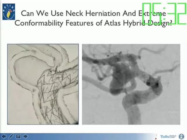 neuroform atlas支架治疗颅内动脉瘤