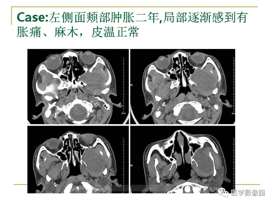 翼腭窝影像解剖及常见病变丨影像天地