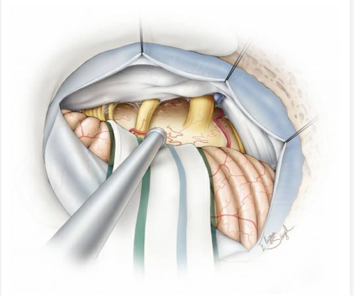 桥小脑角脑膜瘤手术策略与技巧 | the neurosurgical