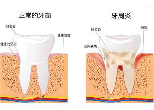 牙周病该如何护理你知道吗?