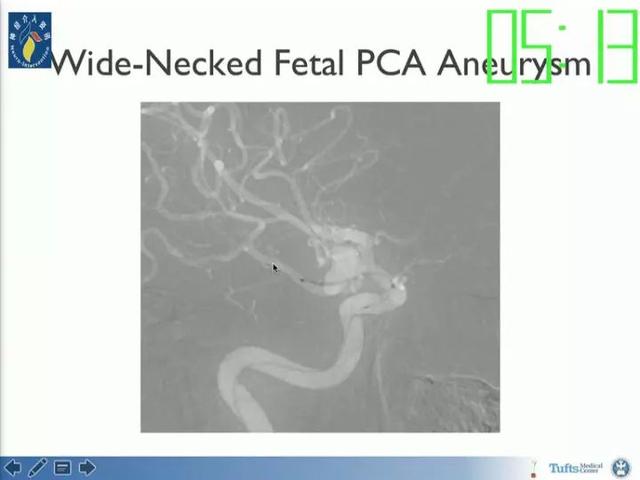 neuroform atlas支架治疗颅内动脉瘤