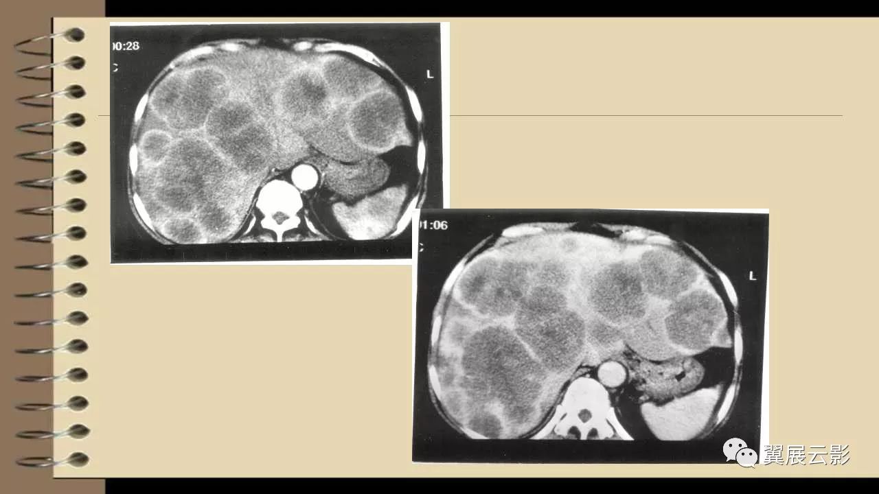 肝脏转移瘤影像病例及鉴别诊断