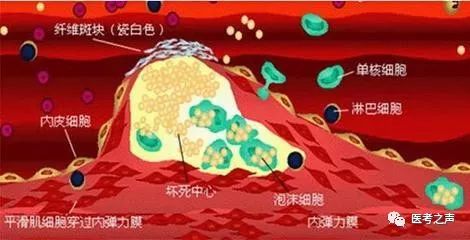 动脉粥样硬化斑块的形成,推理完后就是这么简单