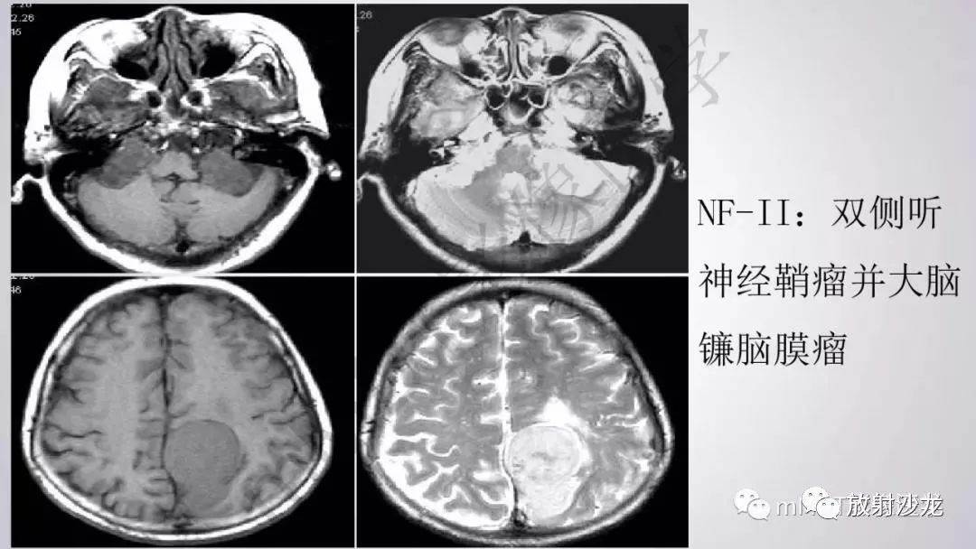 后颅窝常见肿瘤的诊断桥小脑角