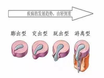 肩间盘突出怎么办