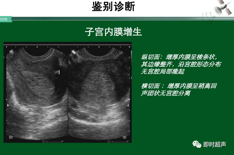 子宫肌瘤的超声诊断与鉴别