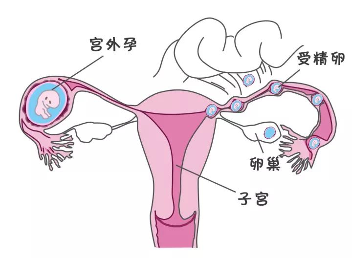 严重起来危及生命的宫外孕最容易盯上这些女性