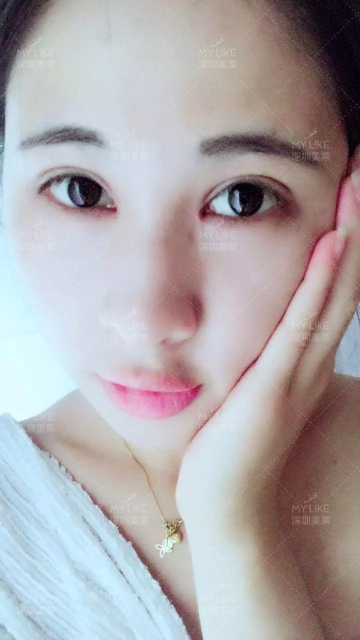 女星,网红必做的双眼皮 开内眼角,我也需要做吗?