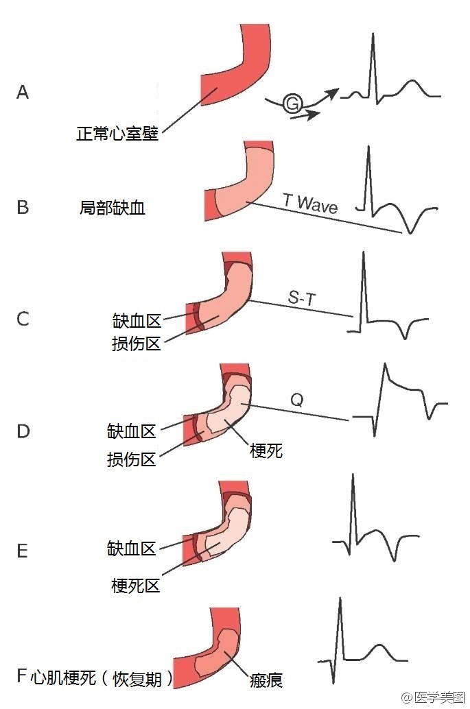 心肌缺血感受是什么样的,怎么发现它?