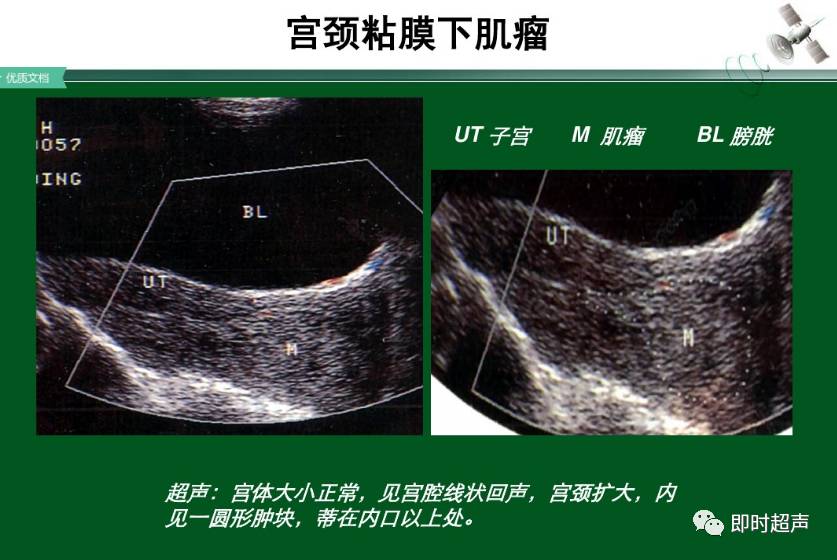 子宫肌瘤的超声诊断与鉴别