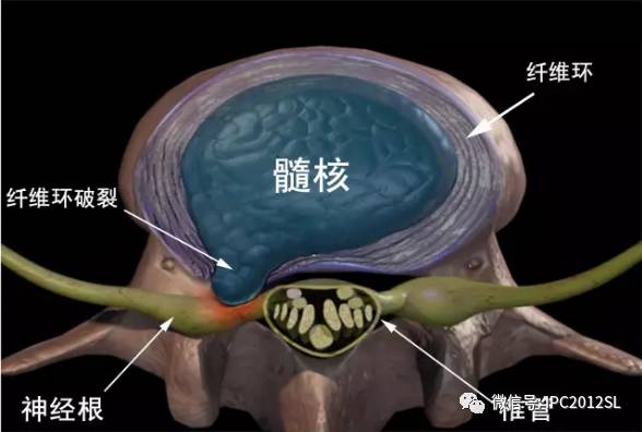 肩间盘突出怎么办