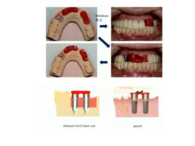 【牙医学堂】修复中咬合记录技巧