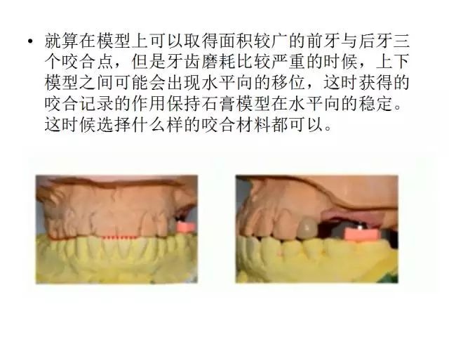 【牙医学堂】修复中咬合记录技巧