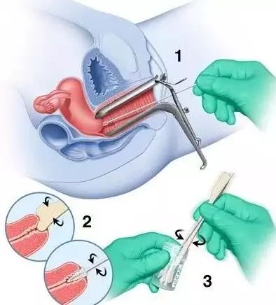 然后,医生用一个鸭嘴样的器械,缓慢扩张阴道,观察阴道壁和子宫颈的