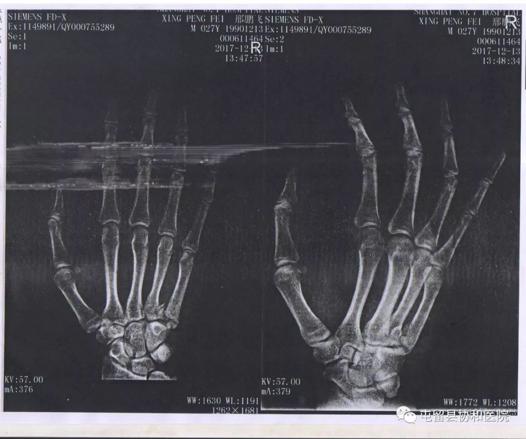 屯留协和医院成功完成首例右手第五掌骨骨折切开复位内固定术