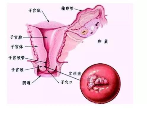 这种癌居然与性生活有关男人女人都需要注意该怎么预防