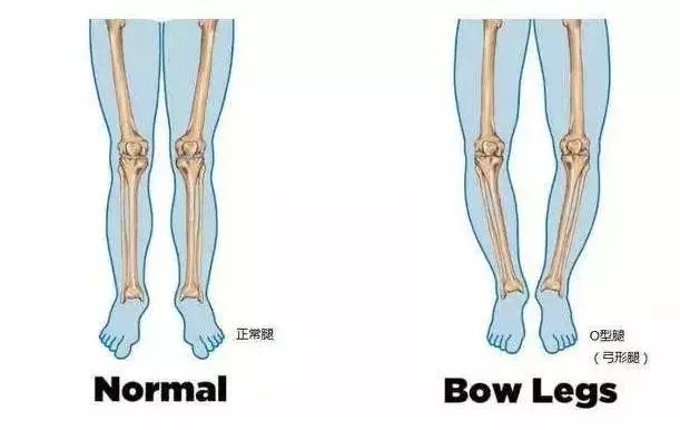 判断o型腿是否严重,也可以用一把尺子量一量: 常态膝距在3厘米以下