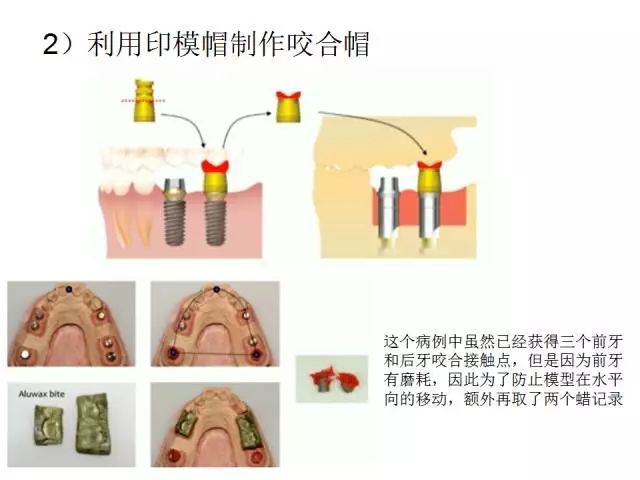 【牙医学堂】修复中咬合记录技巧