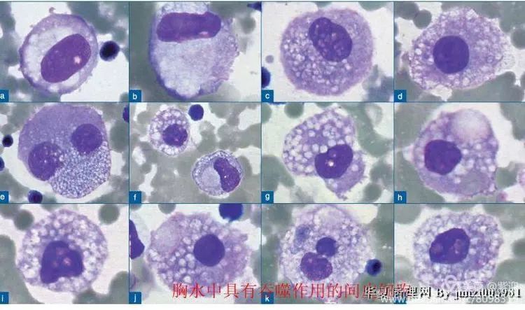 胸腹水细胞图文报告