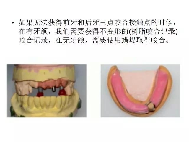 【牙医学堂】修复中咬合记录技巧