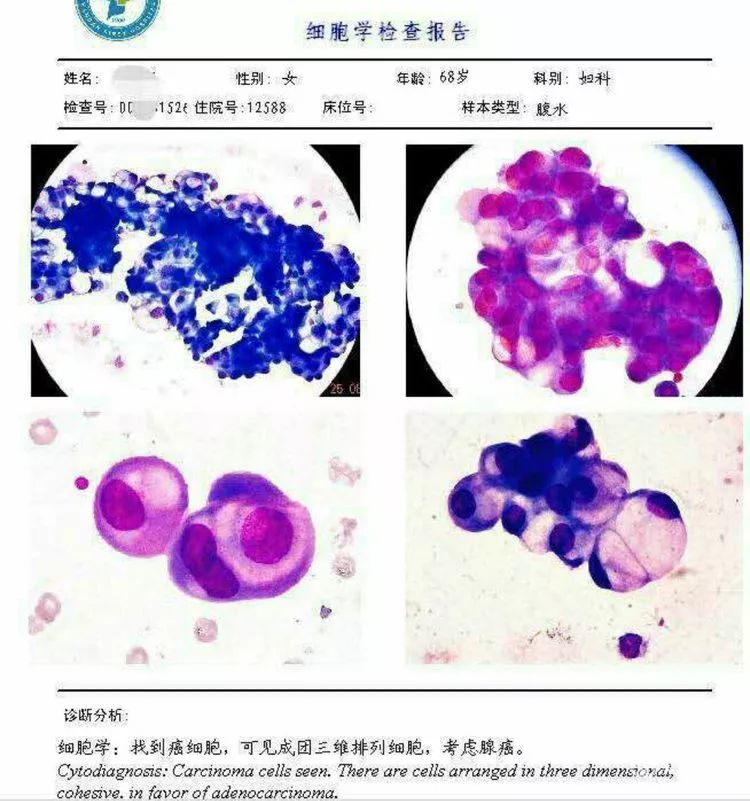 胸腹水细胞图文报告