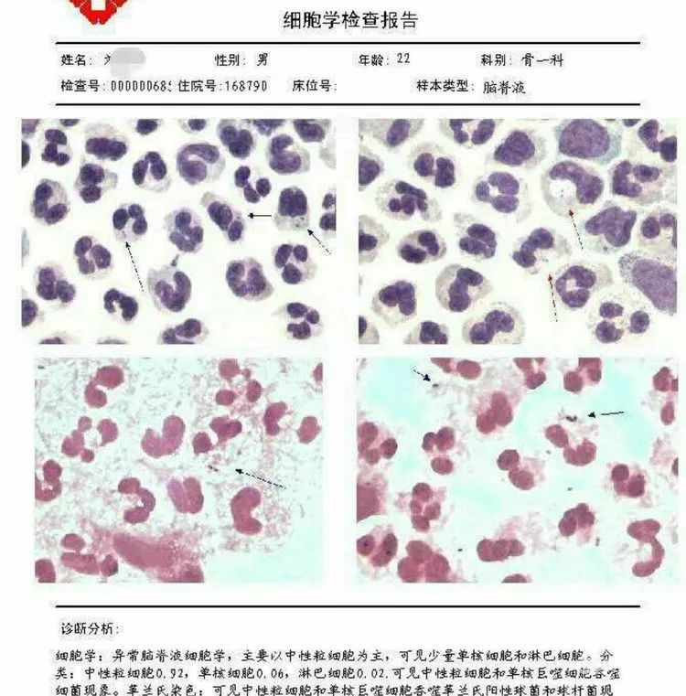 胸腹水细胞图文报告