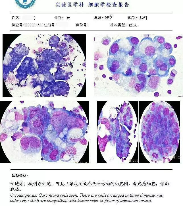 胸腹水细胞图文报告