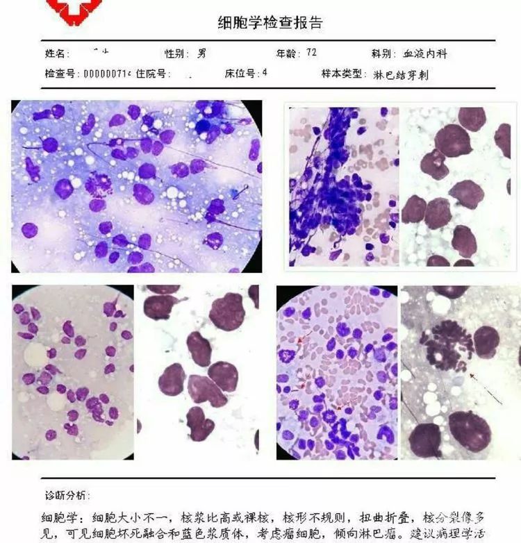 胸腹水细胞图文报告